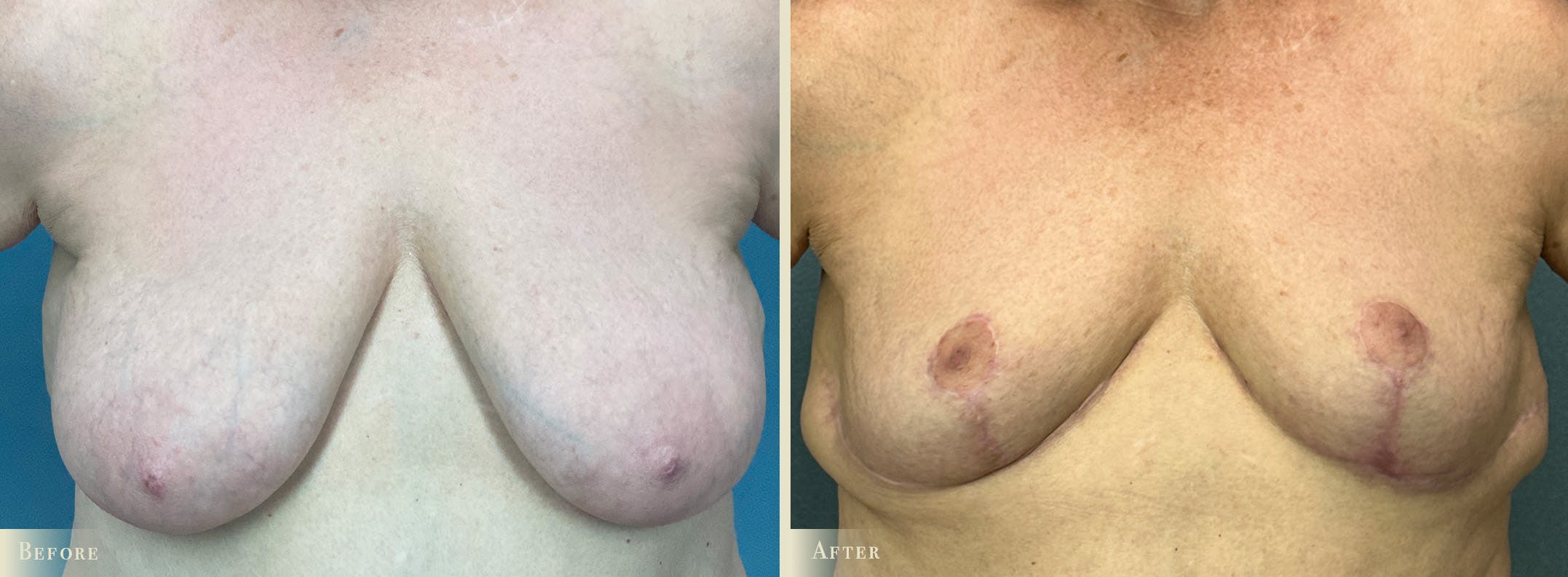 Breast Reduction Before & After Gallery - Patient 471901 - Image 1