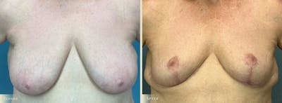 Breast Reduction Before & After Gallery - Patient 471901 - Image 1