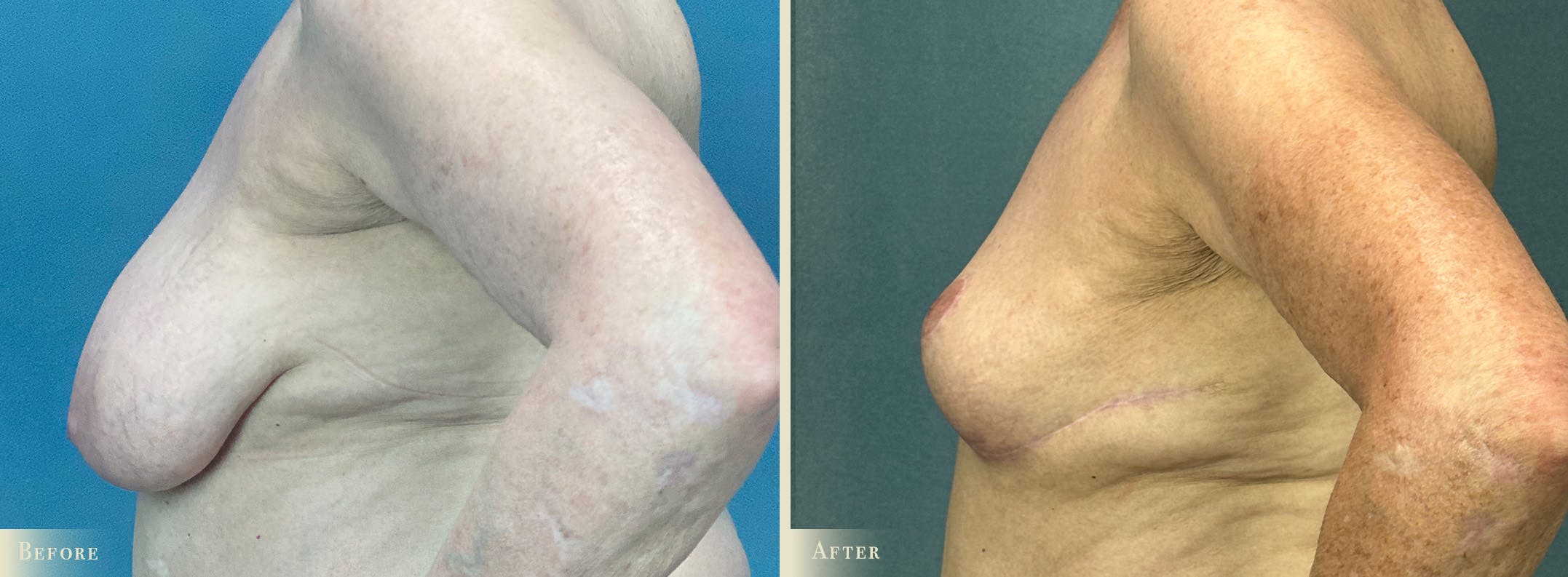 Breast Reduction Before & After Gallery - Patient 471901 - Image 3