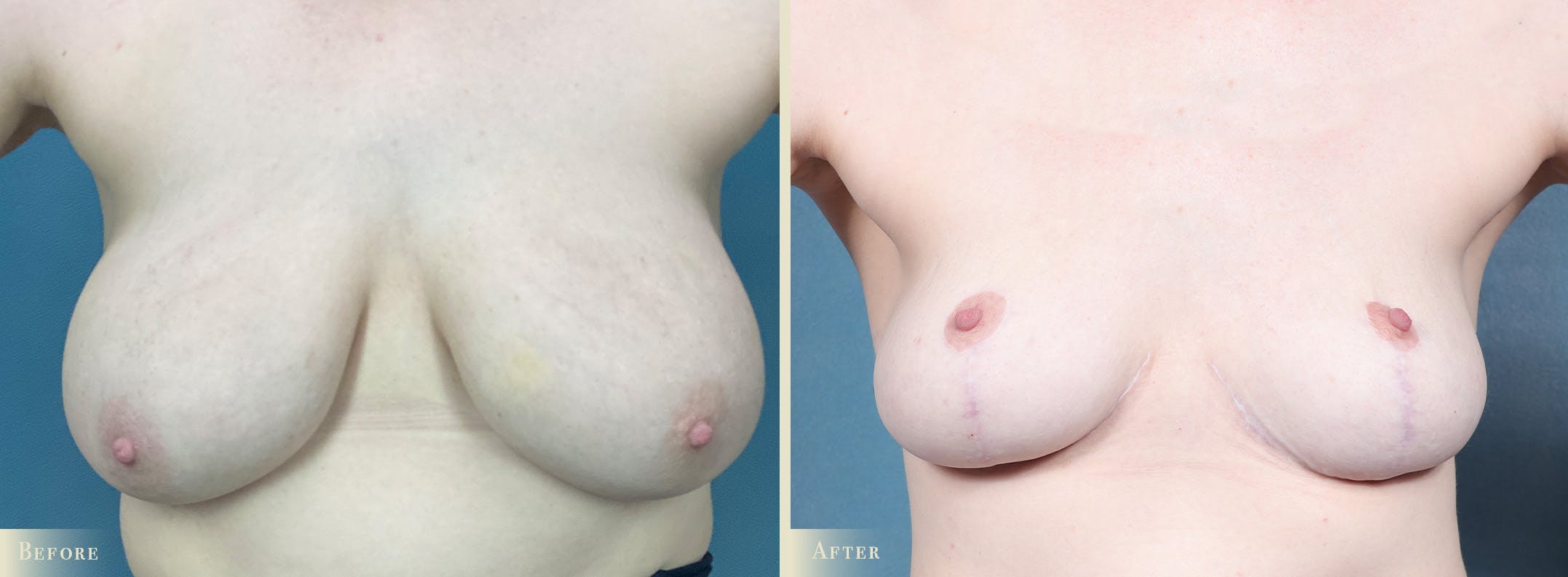Breast Reduction Before & After Gallery - Patient 636244 - Image 1