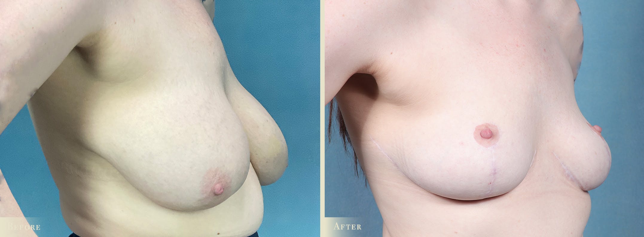 Breast Reduction Before & After Gallery - Patient 636244 - Image 2
