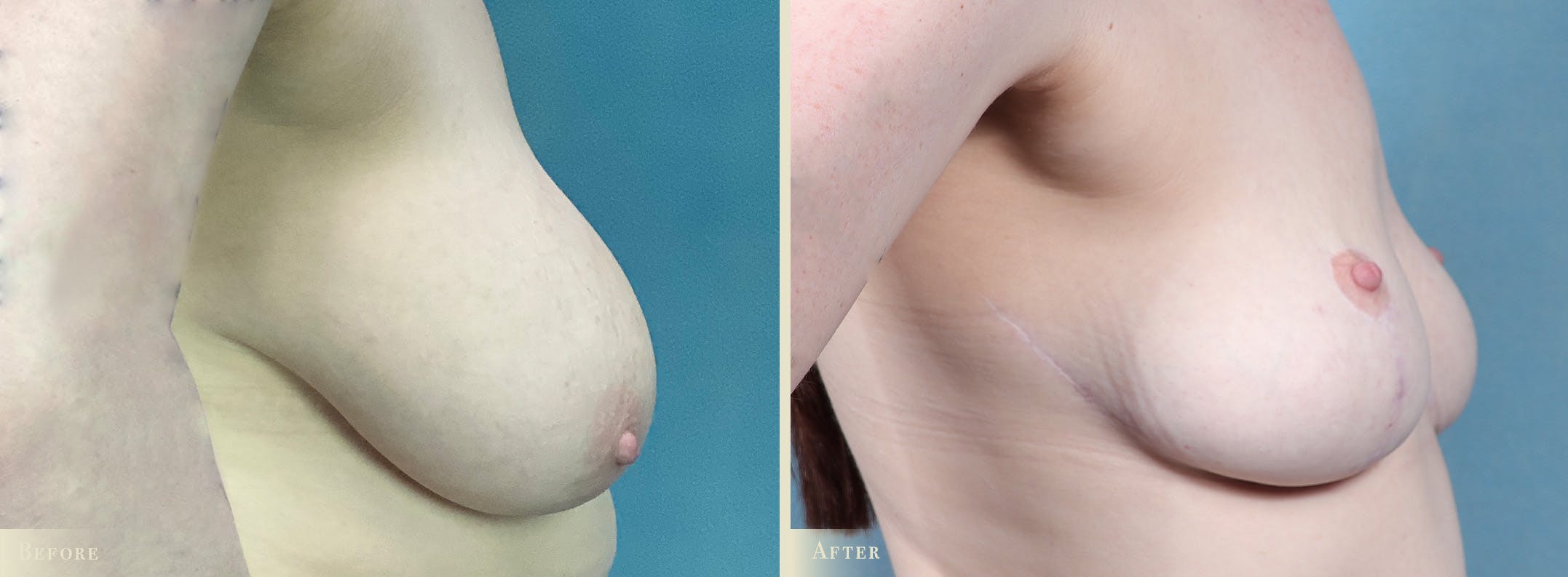 Breast Reduction Before & After Gallery - Patient 636244 - Image 3