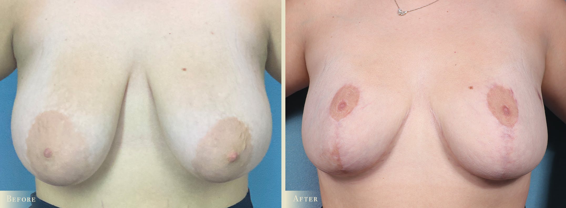 Breast Reduction Before & After Gallery - Patient 207610 - Image 1