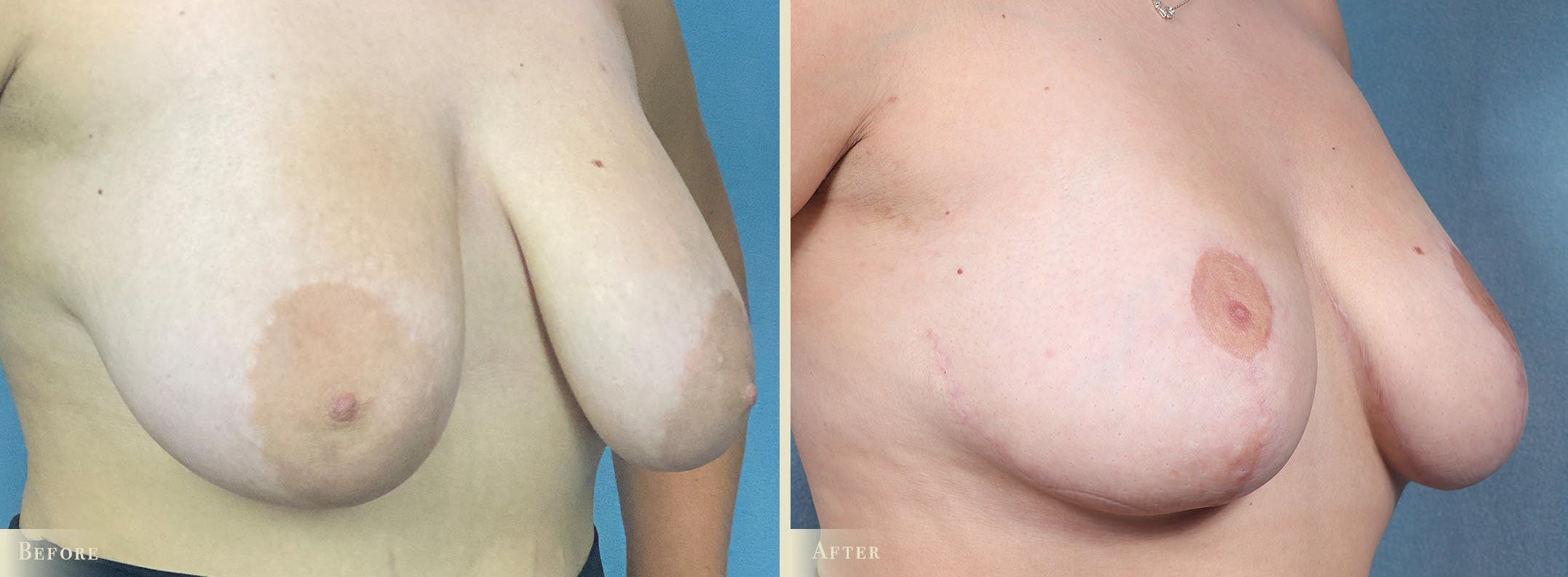 Breast Reduction Before & After Gallery - Patient 207610 - Image 2