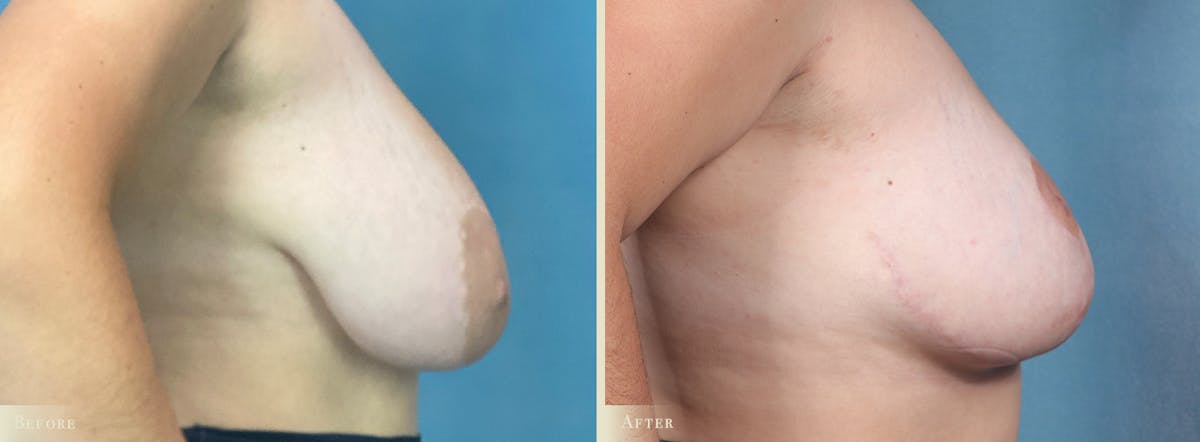 Breast Reduction Before & After Gallery - Patient 207610 - Image 3