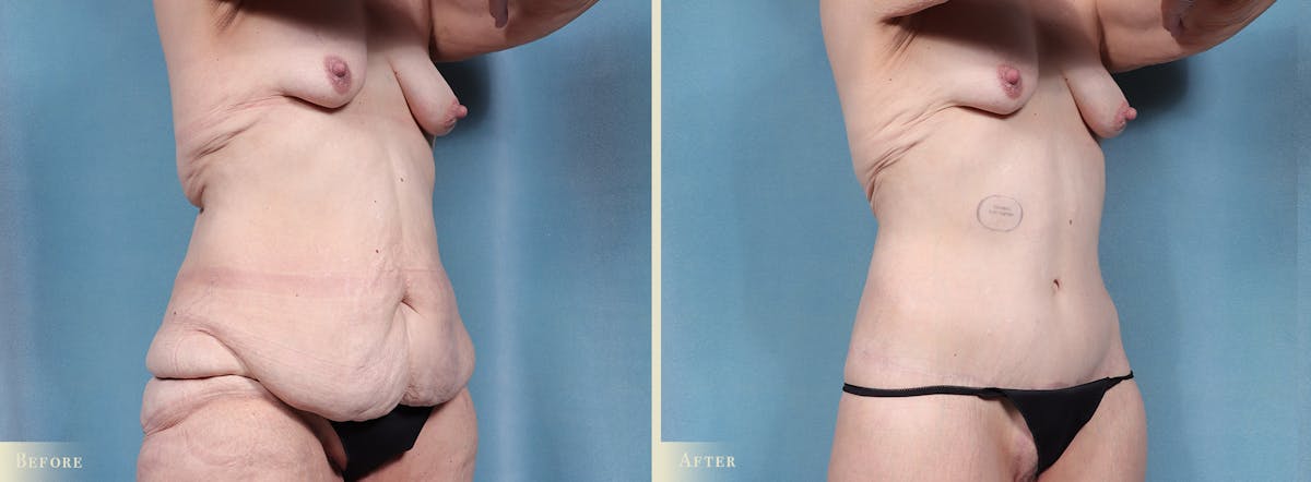 Body Lift Before & After Gallery - Patient 103284 - Image 2