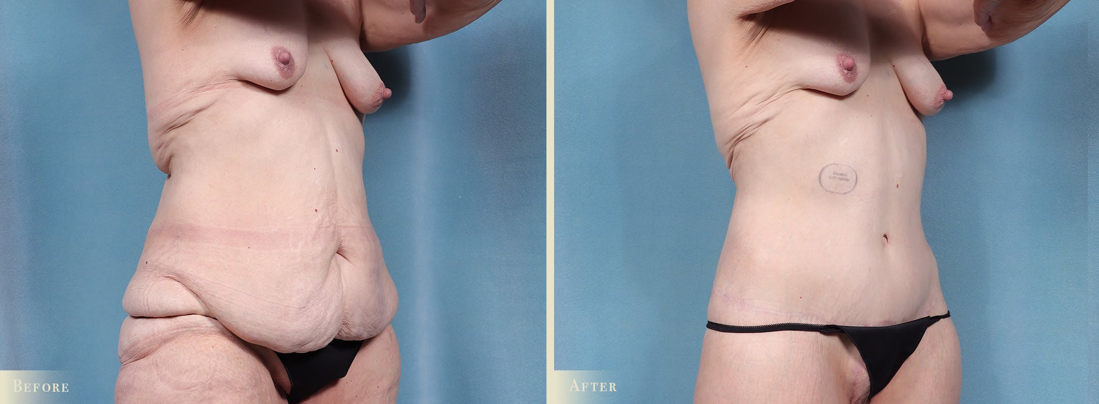 Body Lift Before & After Gallery - Patient 103284 - Image 2