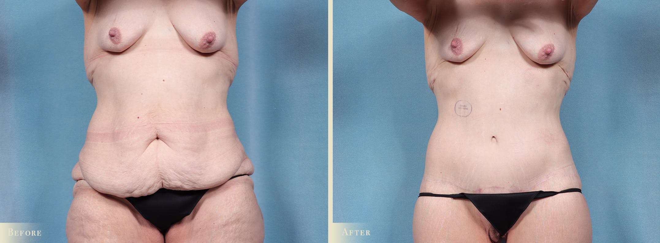Body Lift Before & After Gallery - Patient 103284 - Image 1