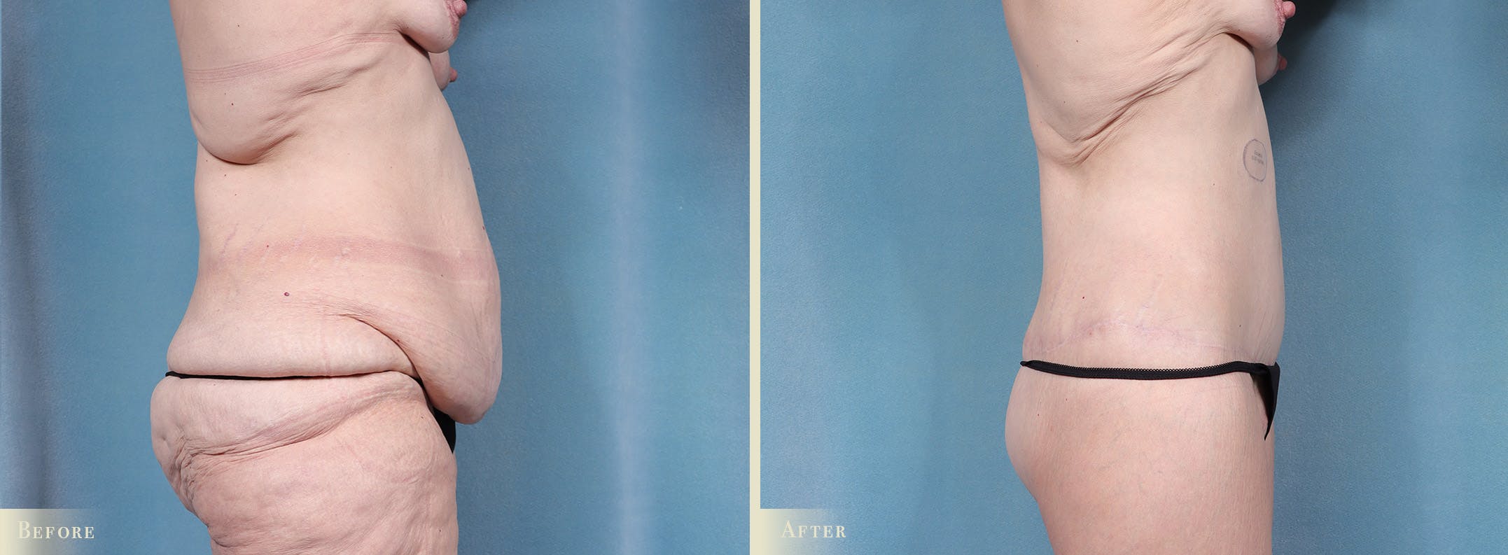 Body Lift Before & After Gallery - Patient 103284 - Image 3