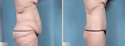 Body Lift Before & After Gallery - Patient 103284 - Image 3