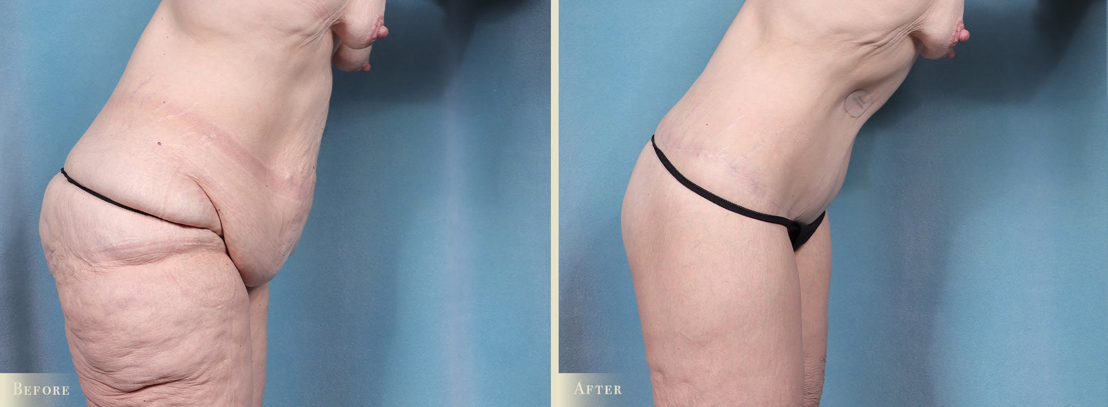 Body Lift Before & After Gallery - Patient 103284 - Image 4