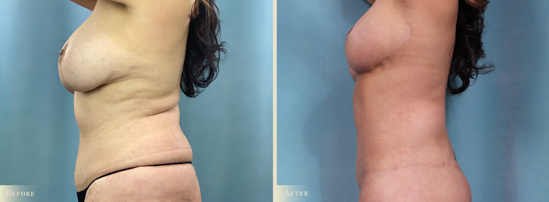 Weight Loss Body Contouring Combination Procedures Before & After Gallery - Patient 375956 - Image 3