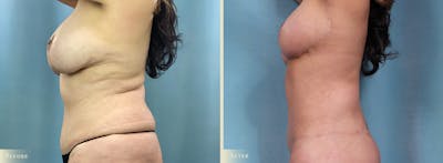 Weight Loss Body Contouring Combination Procedures Before & After Gallery - Patient 375956 - Image 3