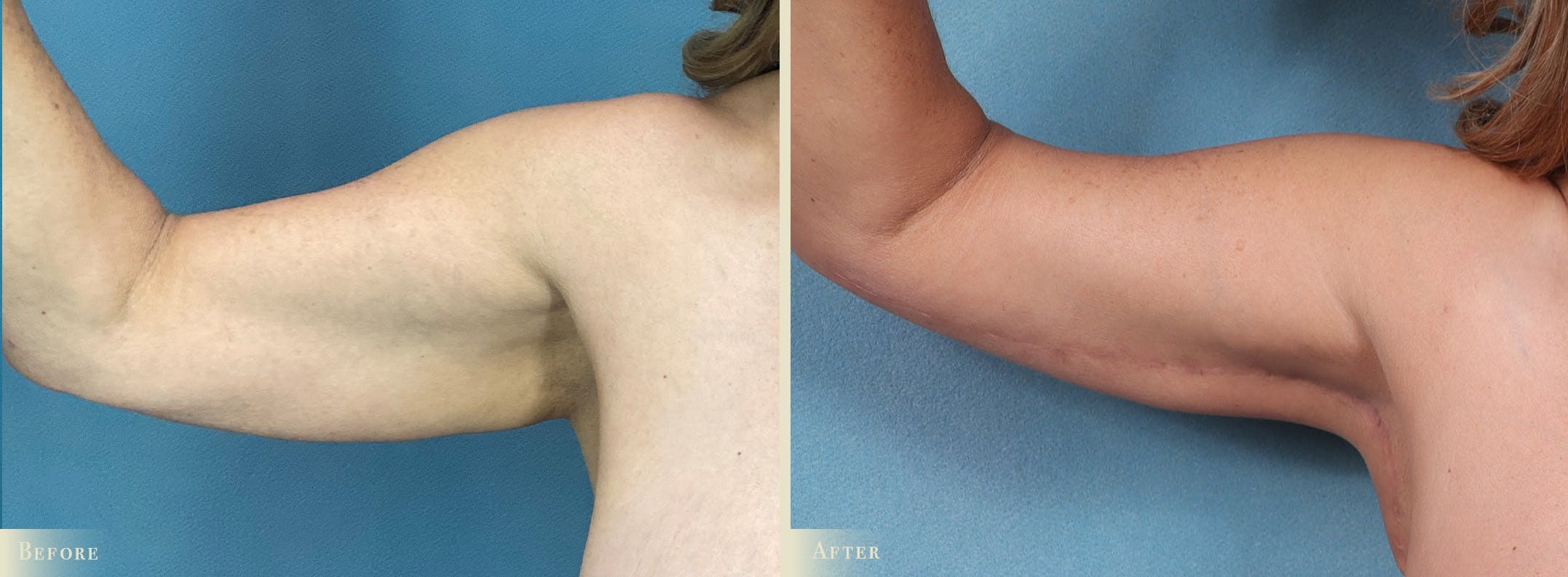 Weight Loss Body Contouring Combination Procedures Before & After Gallery - Patient 375956 - Image 5