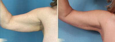 Weight Loss Body Contouring Combination Procedures Before & After Gallery - Patient 375956 - Image 5