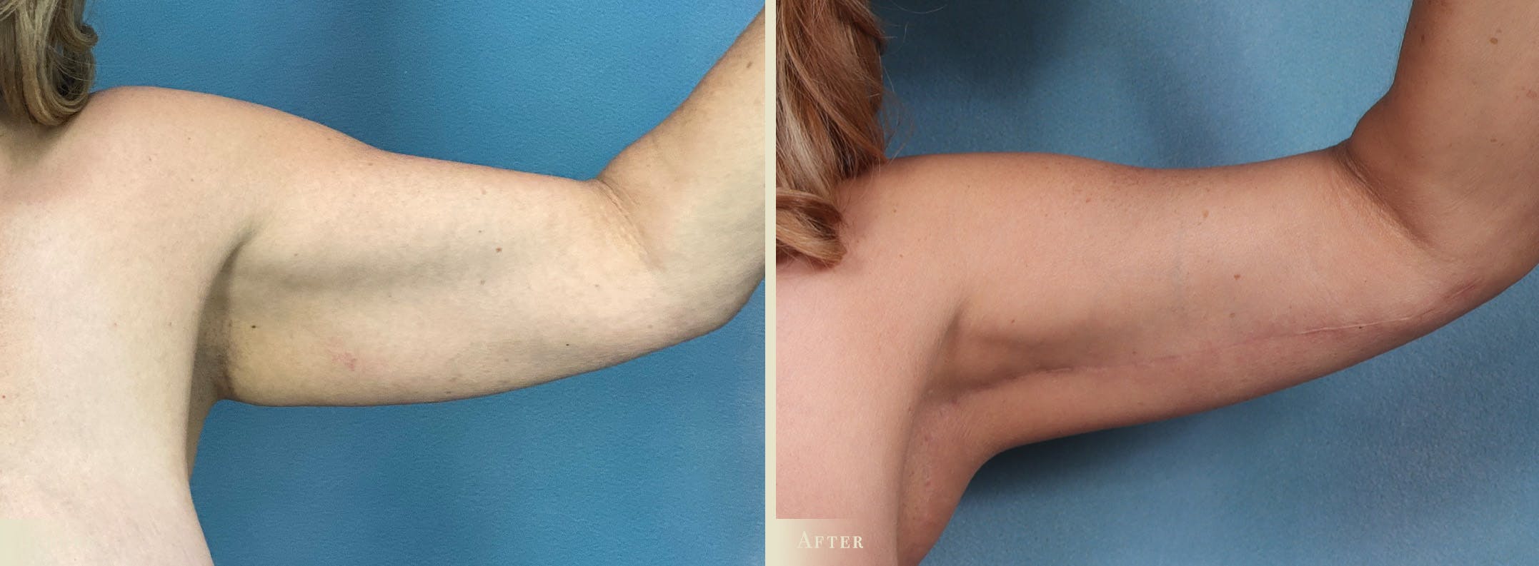 Weight Loss Body Contouring Combination Procedures Before & After Gallery - Patient 375956 - Image 6