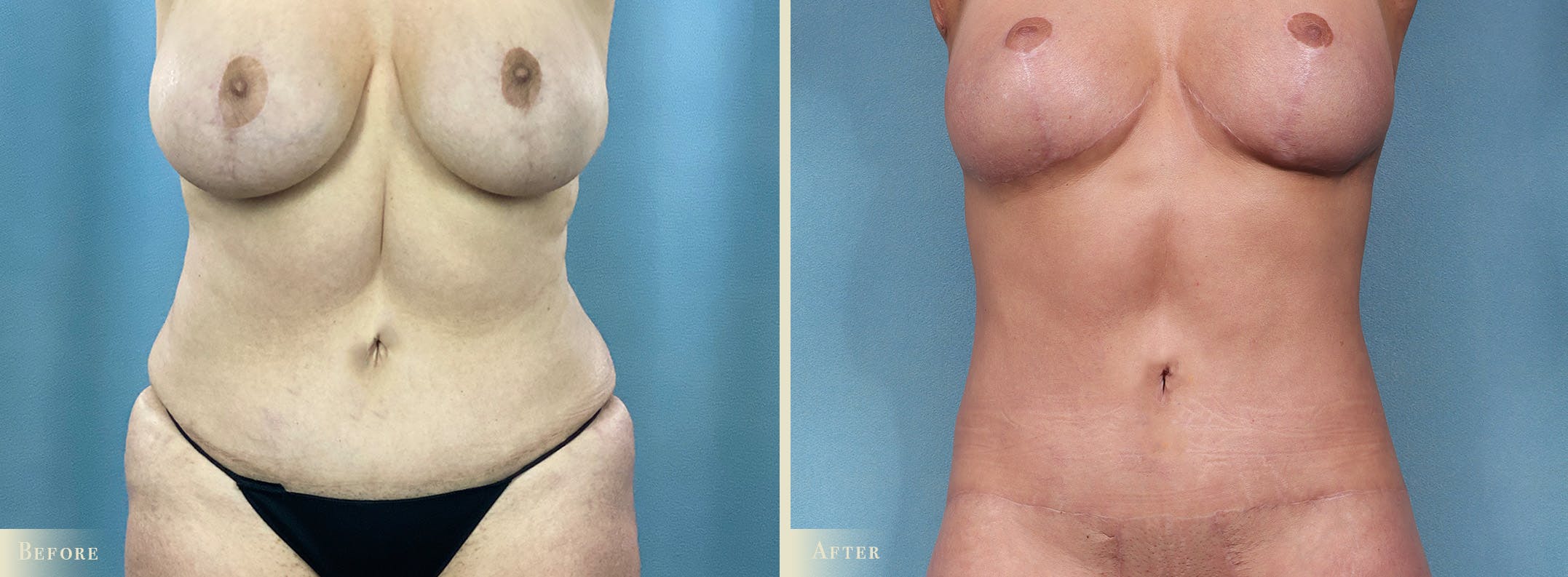Weight Loss Body Contouring Combination Procedures Before & After Gallery - Patient 375956 - Image 1