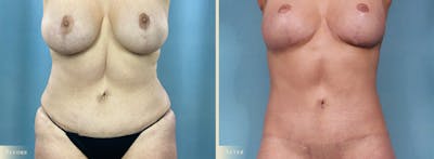 Weight Loss Body Contouring Combination Procedures Before & After Gallery - Patient 375956 - Image 1
