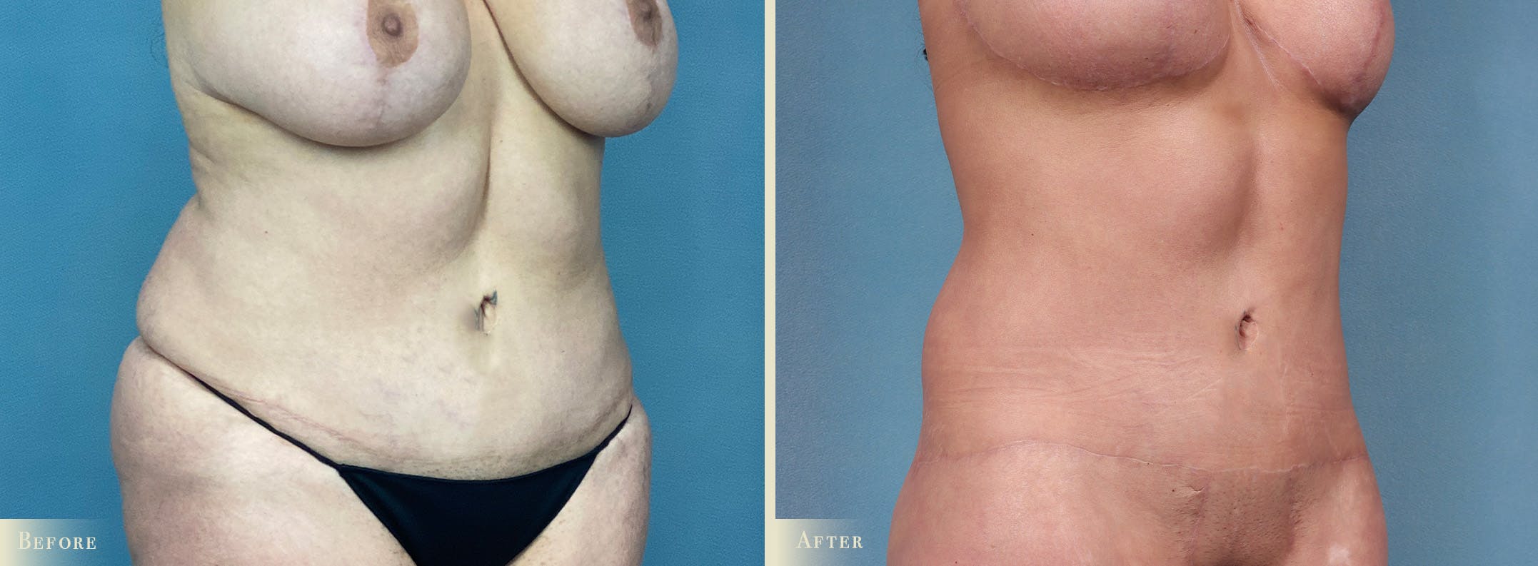 Weight Loss Body Contouring Combination Procedures Before & After Gallery - Patient 375956 - Image 2