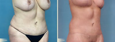 Weight Loss Body Contouring Combination Procedures Before & After Gallery - Patient 375956 - Image 2