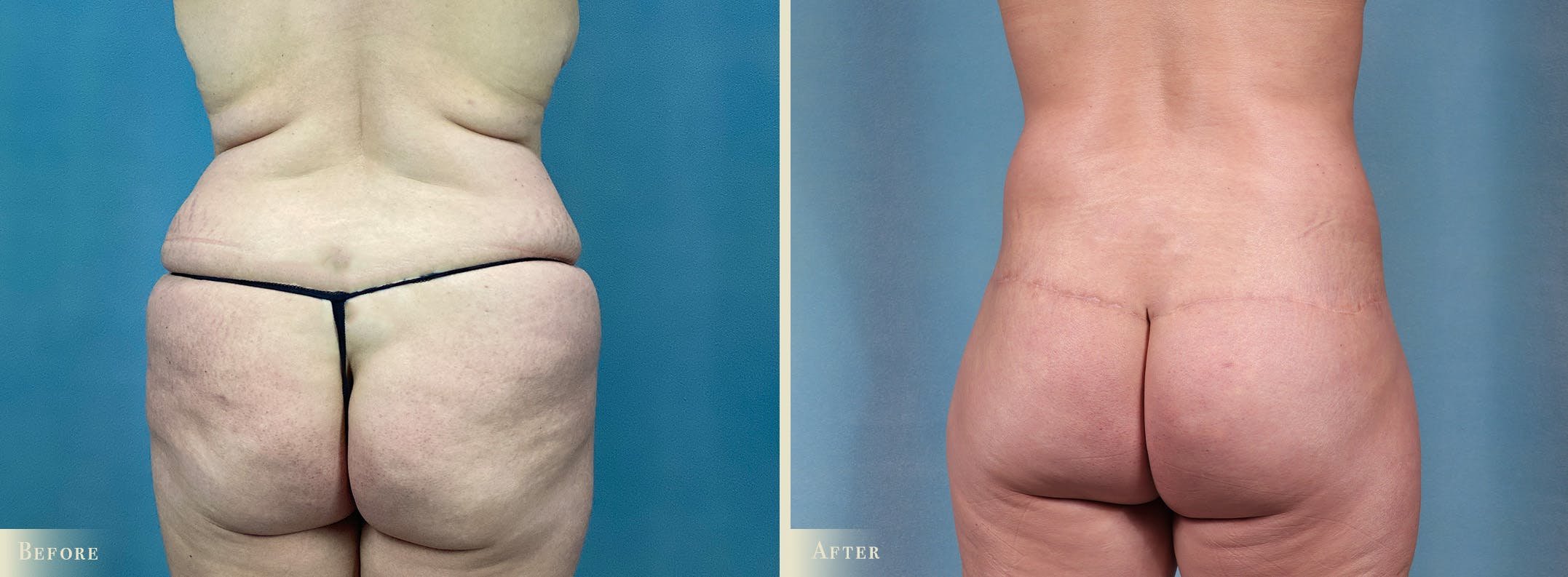 Weight Loss Body Contouring Combination Procedures Before & After Gallery - Patient 375956 - Image 4