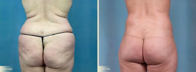 Weight Loss Body Contouring Combination Procedures Before & After Gallery - Patient 375956 - Image 4