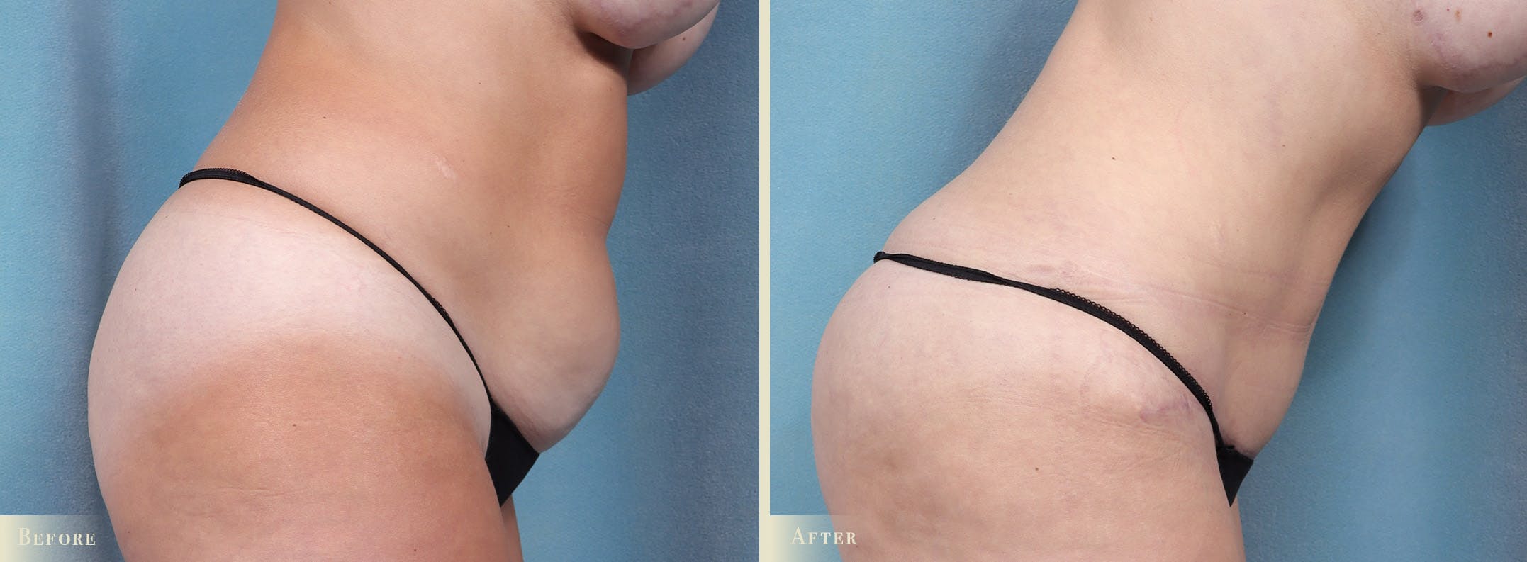Tummy Tuck Before & After Gallery - Patient 344372 - Image 4
