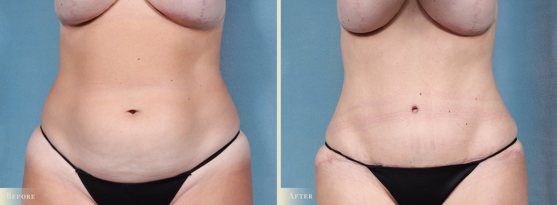 Tummy Tuck Before & After Gallery - Patient 344372 - Image 1