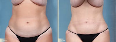 Tummy Tuck Before & After Gallery - Patient 344372 - Image 1