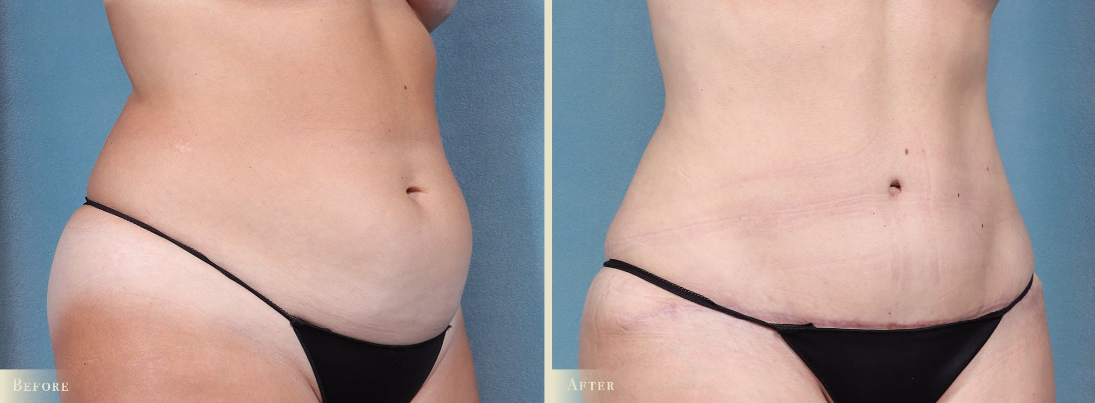 Tummy Tuck Before & After Gallery - Patient 344372 - Image 2
