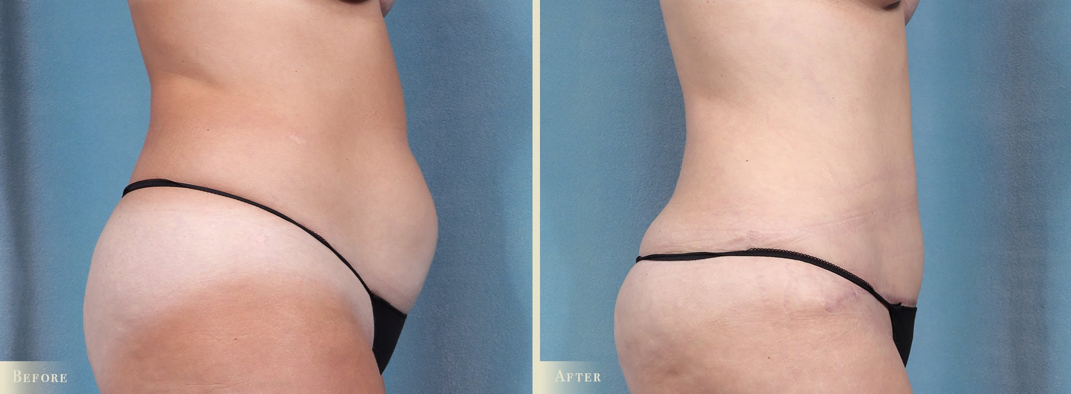 Tummy Tuck Before & After Gallery - Patient 344372 - Image 3