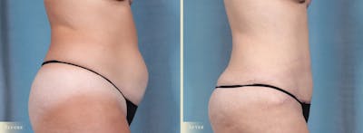 Tummy Tuck Before & After Gallery - Patient 344372 - Image 3