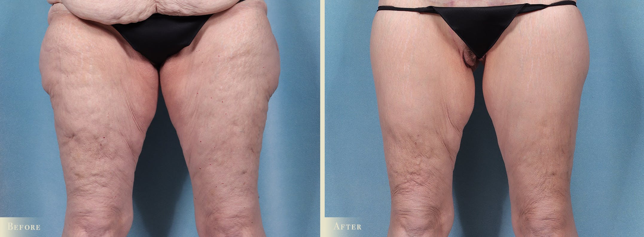 Thigh Lift Before & After Gallery - Patient 345731 - Image 1