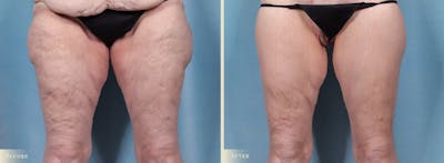 Thigh Lift Before & After Gallery - Patient 345731 - Image 1