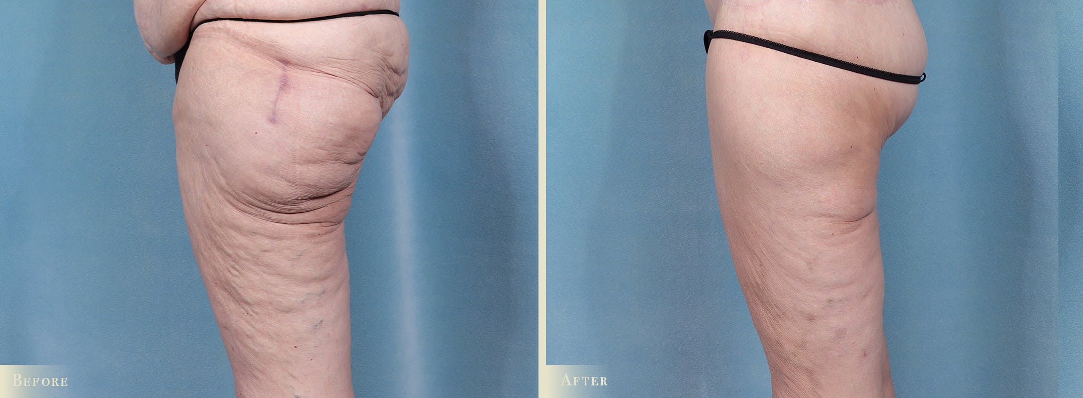 Thigh Lift Before & After Gallery - Patient 345731 - Image 2