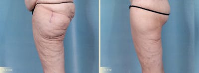 Thigh Lift Before & After Gallery - Patient 345731 - Image 2