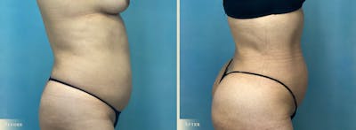 Female Liposuction Before & After Gallery - Patient 190994 - Image 2