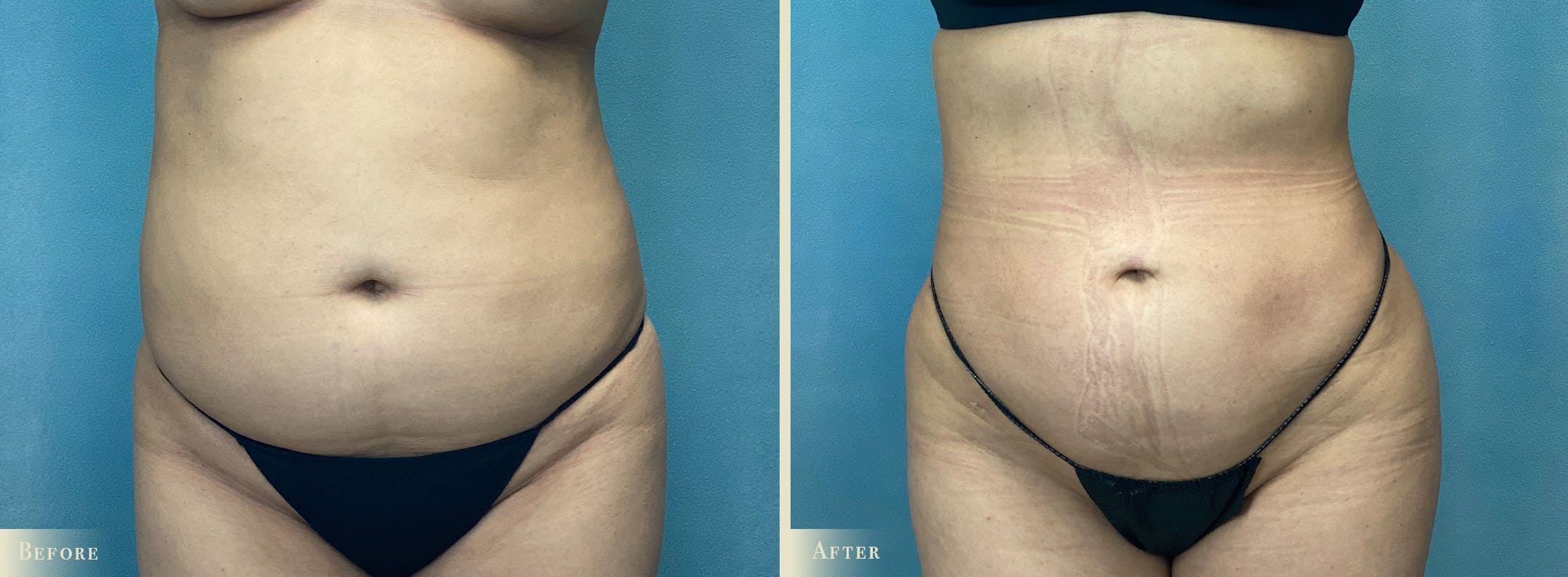 Female Liposuction Before & After Gallery - Patient 190994 - Image 1