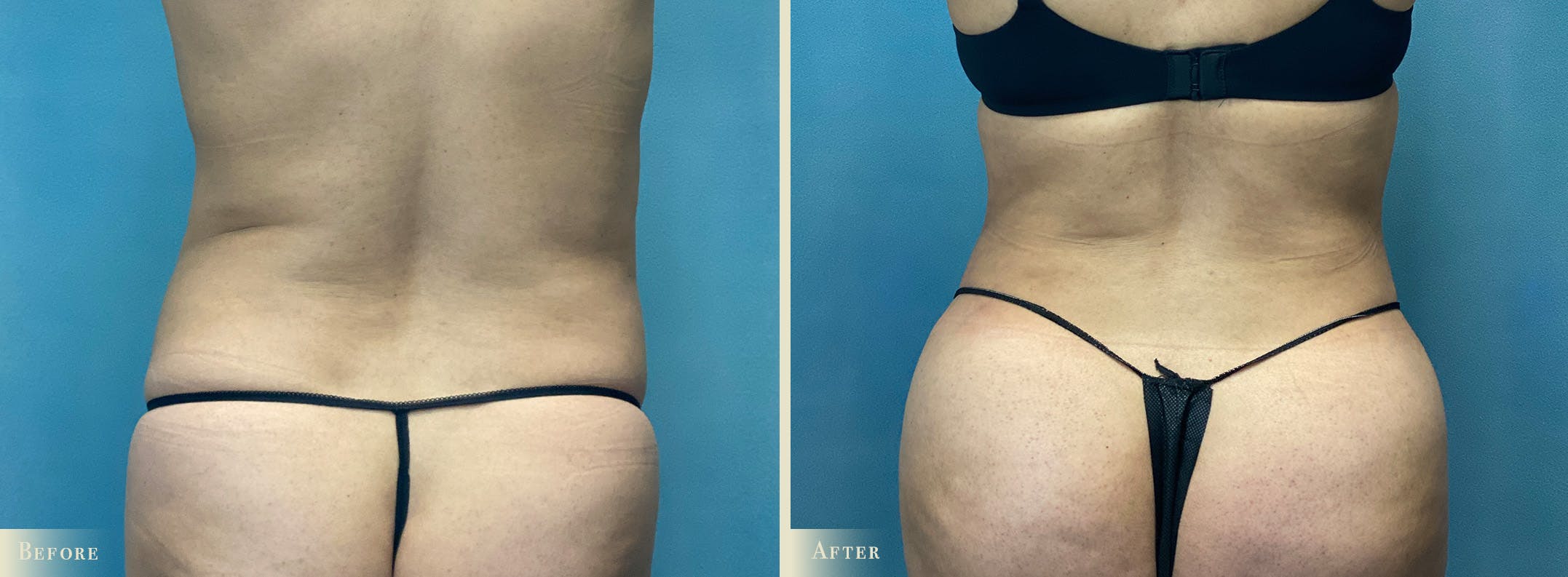 Female Liposuction Before & After Gallery - Patient 190994 - Image 3