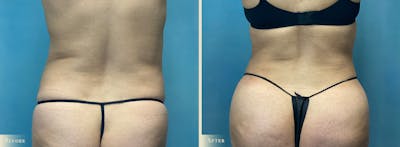 Female Liposuction Before & After Gallery - Patient 190994 - Image 3
