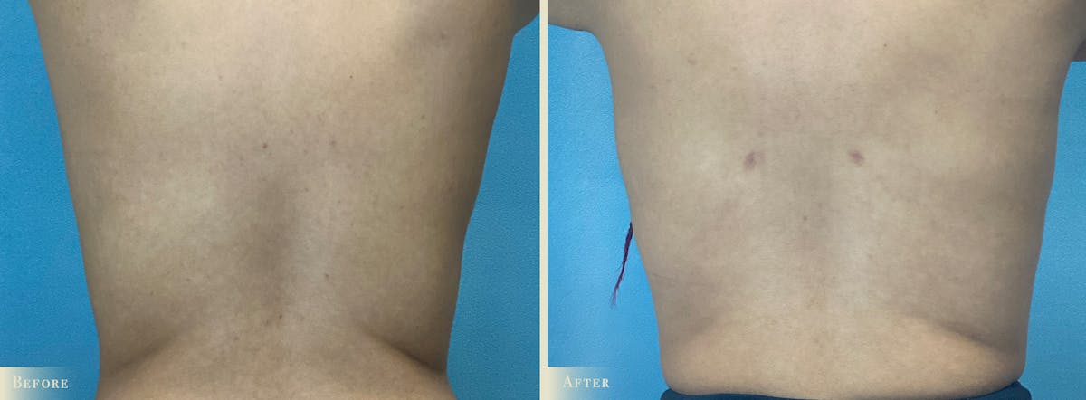 Female Liposuction Before & After Gallery - Patient 122960 - Image 1