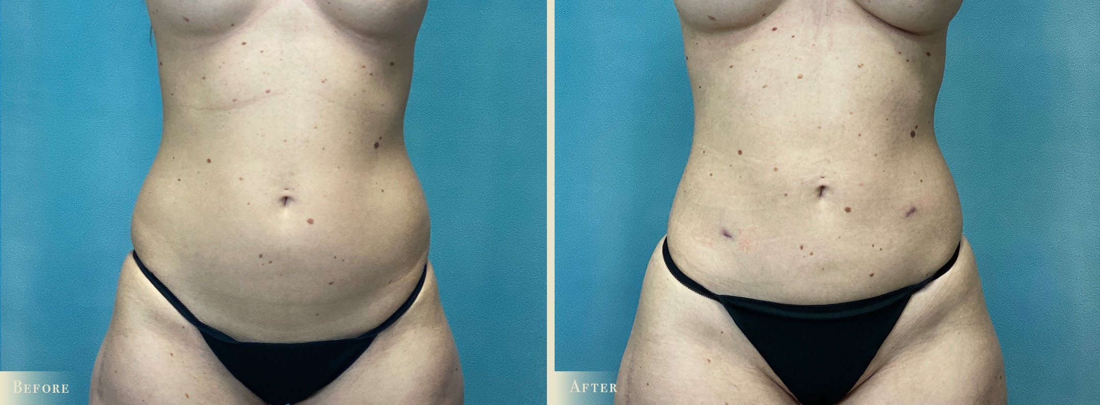 Female Liposuction Before & After Gallery - Patient 382300 - Image 1