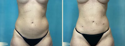 Female Liposuction Before & After Gallery - Patient 382300 - Image 1