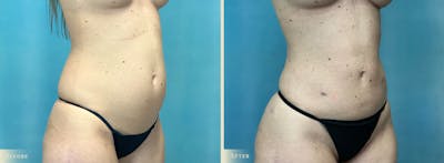 Female Liposuction Before & After Gallery - Patient 382300 - Image 2
