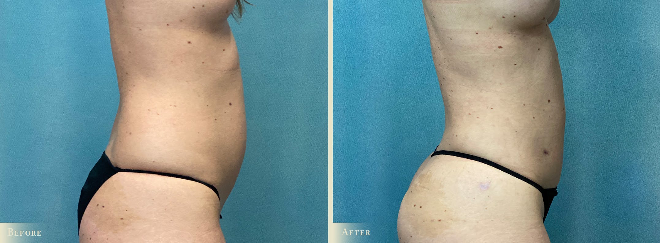 Female Liposuction Before & After Gallery - Patient 382300 - Image 3