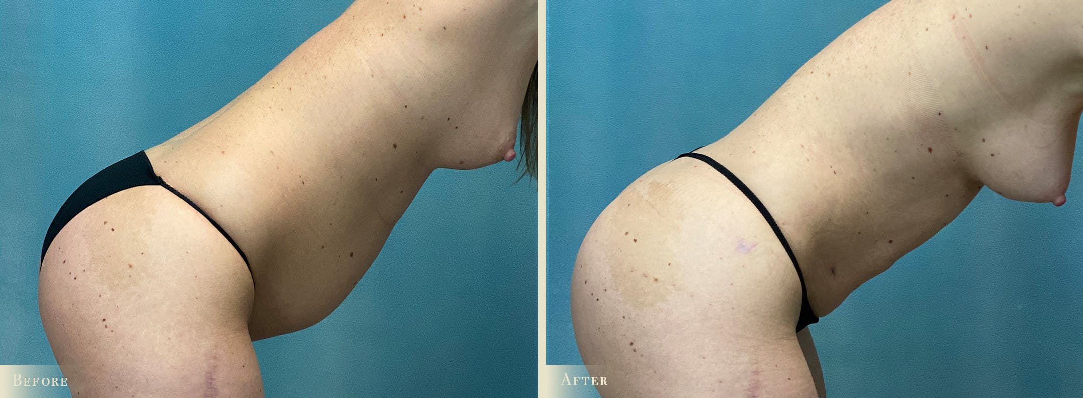 Female Liposuction Before & After Gallery - Patient 382300 - Image 4