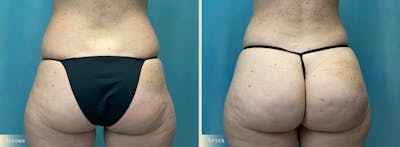 Female Liposuction Before & After Gallery - Patient 382300 - Image 5