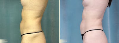 Female Liposuction Before & After Gallery - Patient 293023 - Image 2