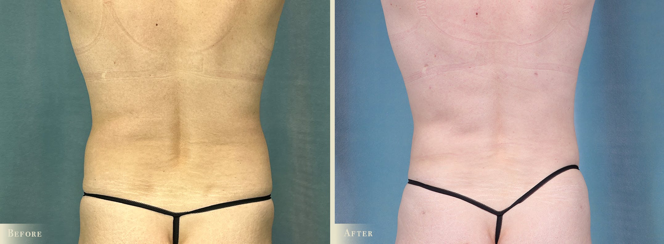 Female Liposuction Before & After Gallery - Patient 293023 - Image 3