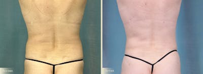 Female Liposuction Before & After Gallery - Patient 293023 - Image 3